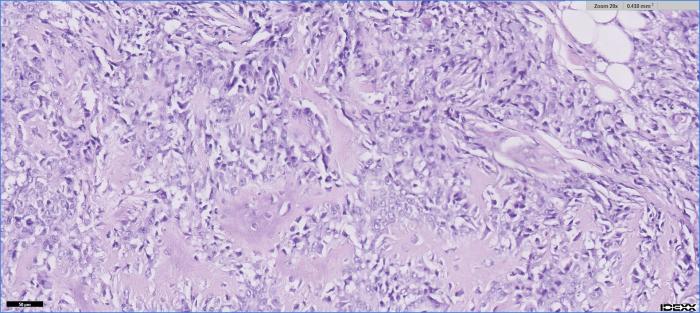 Figura 8. Confirmación histopatológica del diagnóstico de osteosarcoma. Tráquea (bloques D-G): secciones de un mesénquima reactivo fibrovascular en cuyo interior existe una lesión nodular expansiva bien delimitada pero no encapsulada con un crecimiento irregular y zonas de elevada densidad celular en una zona de matriz ósea organizada en forma de trabéculas de tamaño variable delimitando espacios inter trabeculares de incrementada densidad celular. De nuevo en la periferia, existen frecuentes agregados celularmente densos compuestos por células pleomórficas que varían de fusiforme a esteladas asociadas ocasionalmente a áreas irregulares de material osteoide amorfo compatibles con osteoblastos y que poseen un citoplasma eosinofílico inconspicuo asociado a un núcleo excéntrico y redondeado de nucleólo prominente. El índice mitótico es de 56 mitosis/ 10 (x40). La extirpación de la lesión principal es completa aunque existe la presencia de algún crecimiento satélite cercanos al plano de sección. No existen claros émbolos vasculares linfáticos. Tampoco se observa conexión con estructuras óseas Diagnóstico (muslo: osteosarcoma extra esquelético, resección completa con márgenes laterales de 0.5 a 0.2 centímetros. Tráquea: osteosarcoma extra esquelético, resección completa con márgenes laterales de 0.2 a 0.3 centímetros aunque con crecimiento satélite cercano al plano de sección) (imagen cortesía de Laboratorio IDEXX).