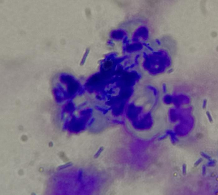 Figura 3. Citología de la muestra de orina tomada de la pelvis del riñón derecho. Nótese la fagocitosis de bacilos por parte de neutrófilos.