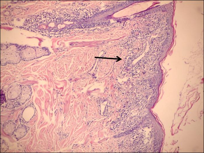 Figura 4. (A) Imagen histopatológica de la piel en la que se observa una dermatitis de interfase liquenoide en banda (flecha negra) (x100, H&E). (B) Imagen histopatológica de la unión dermoepidérmica. En la dermis se observa una moderada reacción inflamatoria compuesta principalmente por linfocitos, plasmocitos y macrófagos vacuolizados. También se observa melanina en el interior del citoplasma de algunos macrófagos (flechas negras). En las células del estrato basal de la epidermis se ven células con degeneración hidrópica (flechas rojas) (x400, H&E).