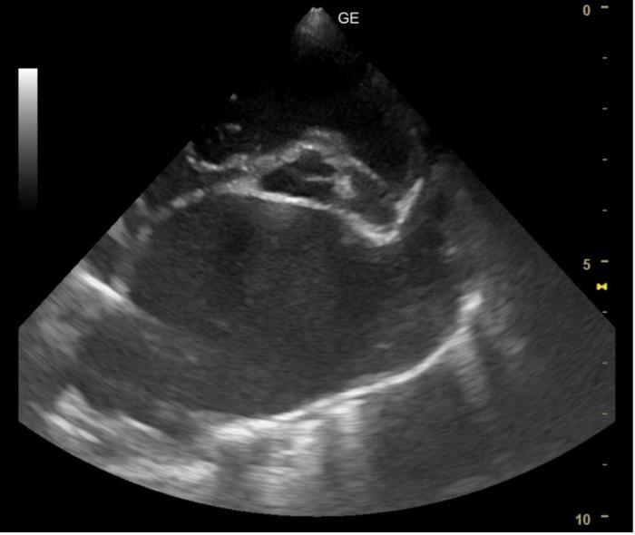 Figura 7. Imagen ecográfica obtenida mediante una proyección paraesternal derecha en eje corto a nivel de la base cardíaca en la que puede visualizarse una marcada dilatación del AI.