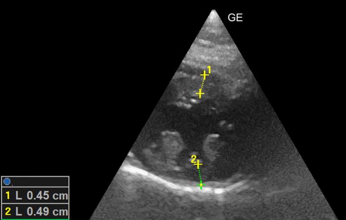 Figura 5. Corte paraesternal derecho, en eje corto, optimizado a nivel del ventrículo izquierdo. Valoración bidimensional del grosor diastólico con normalización de las medidas (RR < 6 mm).