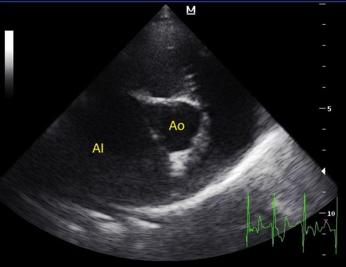 Figura 3. Vista paraesternal derecha eje corto optimizada para atrio izquierdo (AI). Se observa severa dilatación del atrio izquierdo (AI). Ao: aorta.