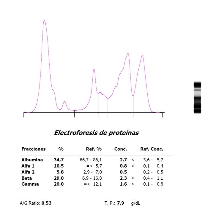 Figura 3. Hipoalbuminemia, aumento de proteínas de fase aguda e hipergammaglobulinemia en una coneja con neoplasia pulmonar y metástasis hepática. El pico tras la albúmina es de origen incierto, aunque podría deberse a la antibioterapia que la paciente estaba recibiendo.