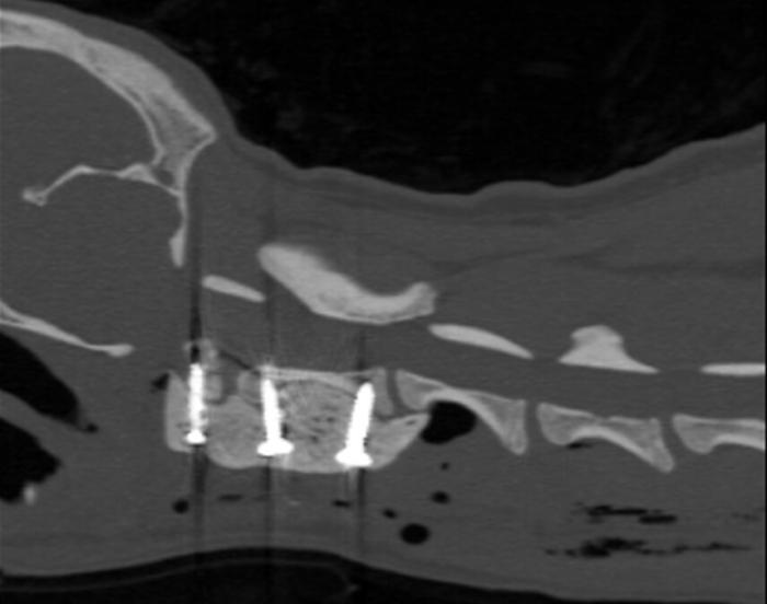 Figura 3. Vista sagital del área cervical mediante TAC tras la estabilización quirúrgica con tornillos y cemento.