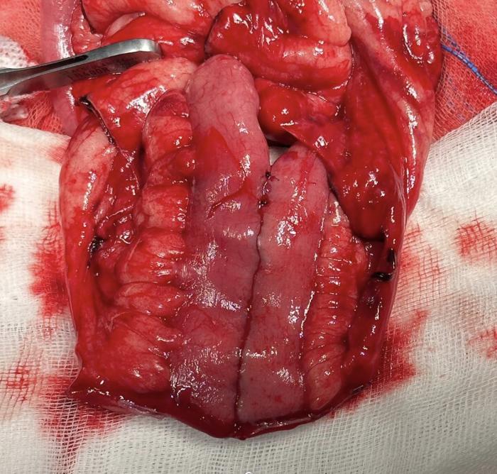 Figura 3. Imagen intraquirúrgica. Anastomosis laterolateral con grapadora quirúrgica. Resultado final.