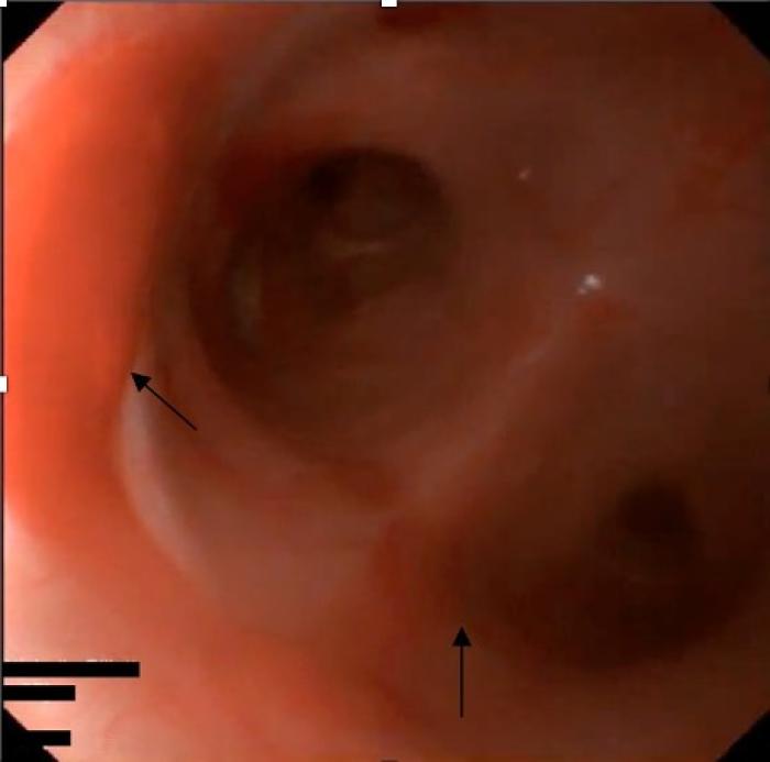 Figura 2. La imagen obtenida durante la broncoscopia muestra la presencia de secreción serosanguinolenta (flechas) a nivel de la bifurcación traqueal.