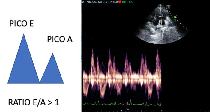 Figura 4. Patrón transmitral normal en un Teckel de 3 años. Onda E superior a onda A, ratio E/A >1.