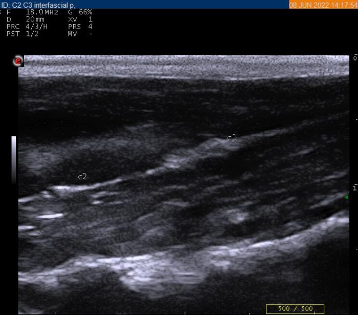 Figura 4. Imagen ecográfica del plexo cervical a nivel de C2-C3. Se observa la fascia (hiperecoica) del músculo homotransverso con 2 pequeños abultamientos correspondientes a C2 y C3.