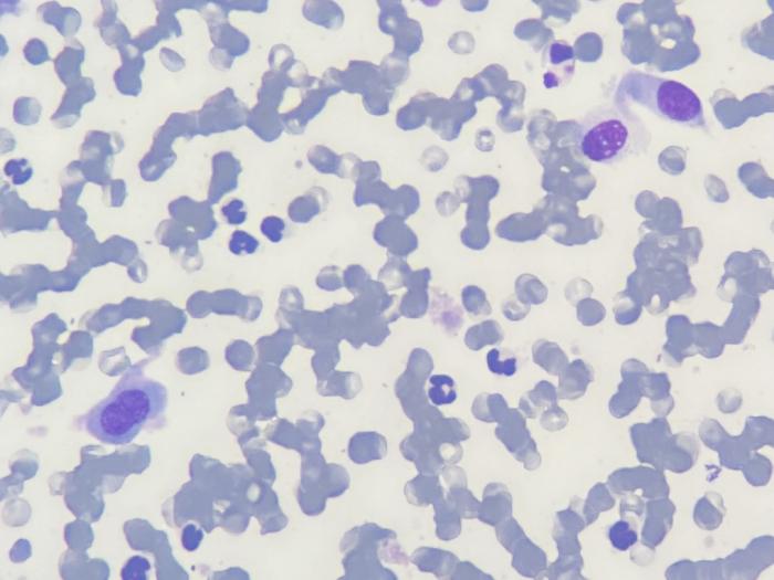 Figura 2. PAF. (A) Escasas células mesenquimales con criterios de malignidad junto con escaso componente inflamatorio. (B) Célula mesenquimal mostrando cariomegalia y múltiples nucléolos. (C) Célula mesenquimal binucleada con múltiples vacuolas claras intracitoplasmáticas.      