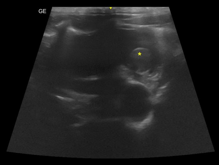 Figura 14. Corte paraesternal izquierdo craneal optimizado para la visualización de la aurícula izquierda. Se observa tanto señal de humo como la presencia de un tromboémbolo.