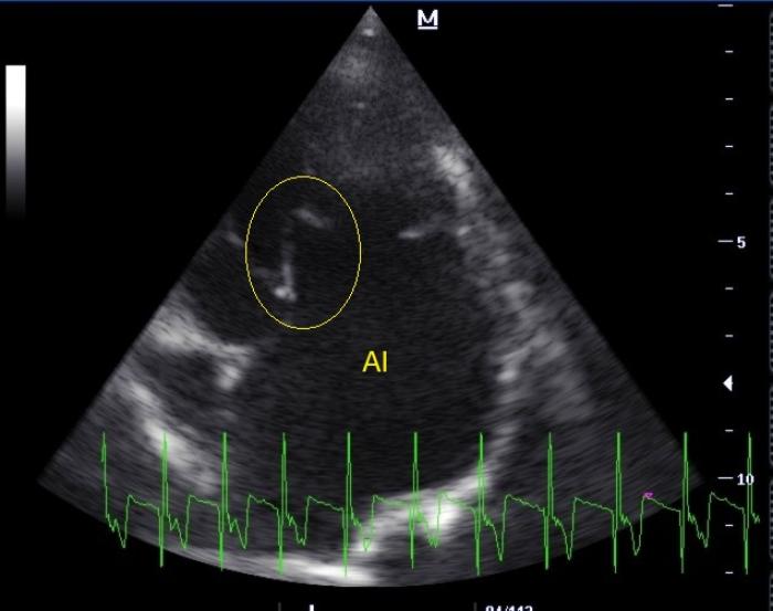 Figura 6. Vista paraesternal izquierda apical 4 cámaras. La válvula mitral presenta morfología de palo de hockey en su apertura, particularmente en la valva septal (elipse amarilla).