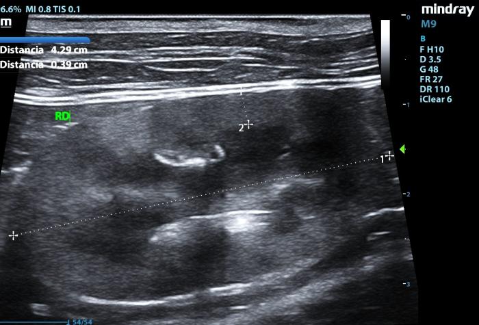 Figura 2. (A) Infarto renal crónico focal en región craneolateral. (B) Infarto renal crónico amplio tras anemia hemolítica. (C) Infartos renales múltiples en un gato con CMH.