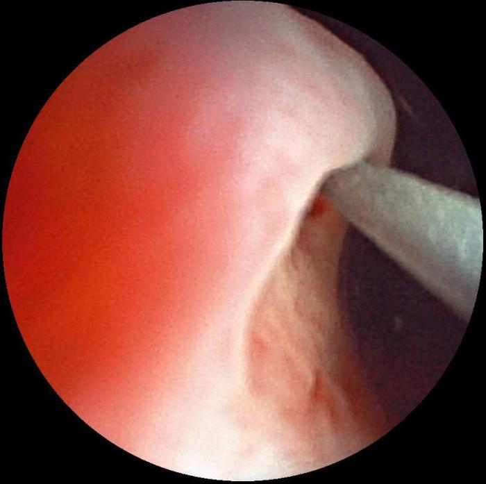 Figura 6. Implantación de catéter JJ en abordaje endoscópico retrógrado. (A) Cateterización endoscópica con guía hidrofílica. (B) Ascenso de guía hidrofílica (flecha verde) por el uréter (control fluoroscópico). (C) Ascenso de guía hidrofílica (flecha verde) hasta pelvis renal con formación de bucle (control fluoroscópico). (D) Rectificación de guía hidrofílica (flecha verde) y eliminación del bucle. (E) Intercambio de guía hidrofílica (flecha verde) por catéter de lavado (flecha roja) para ureteropielografía retrógrada. (F) Ureteropielografía retrógrada con contraste iodado al 50 %. (G) Posicionamiento de pig-tail proximal del catéter JJ.