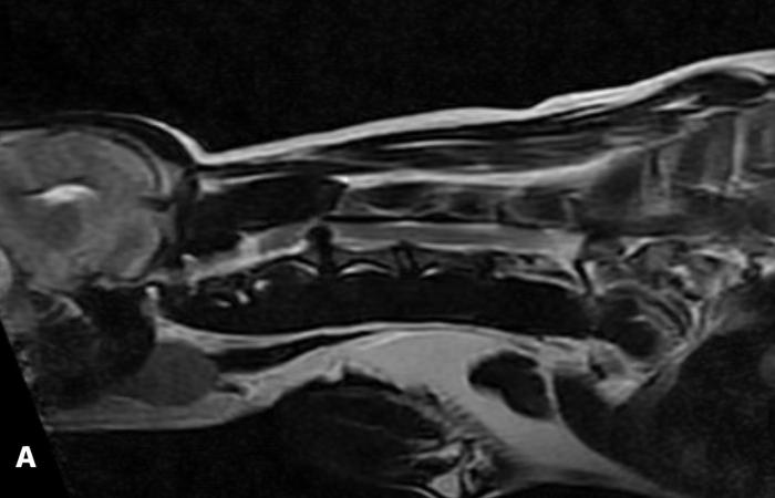 Figura 1. Resonancia magnética cervical donde se observa la severidad de la compresión medular por la extrusión discal C2-C3. (A) Corte sagital en T2. (B) Corte coronal en T2. (C) Corte axial en T2.
