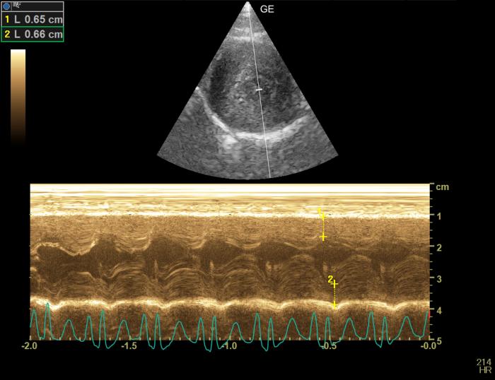 Figura 1. Ecocardiografía en Modo M . Corte paraesternal derecho, en eje corto, optimizado a nivel del ventrículo izquierdo. Medidas diastólicas de la pared del ventriculo izquierdo con incremento tanto del grosor de la pared libre como la del septo interventricular (RR < 6 mm).