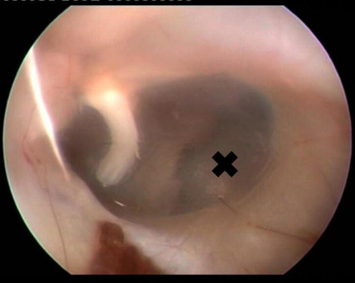 Figura 8. La miringotomía debe realizarse en la zona caudoventral de la pars tensa del tímpano (señalada con una cruz).