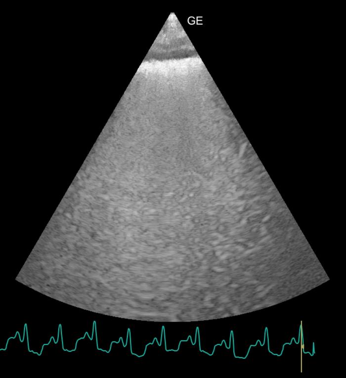 Figura 6. Ecografia transtorácica focalizada en los pulmones. Presencia de numerosas lineas B dando el aspecto conocido como pulmón blanco.