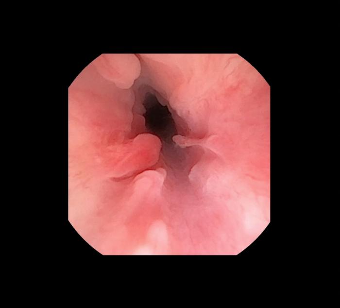 Figura 2. Uretritis proliferativa secundaria uretritis crónica.