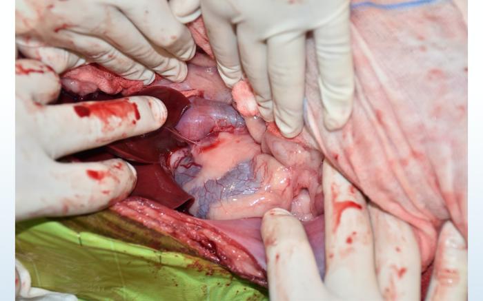 Figura 3. Imagen quirúrgica donde se observa vena cava caudal, que se apreciaba distendida por el trombo tumoral, desde su unión con la vena frenicoabdominal derecha hasta su porción hepática.