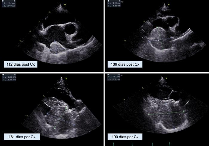 Figura 9. El seguimiento ecocardiográfico muestra un aumento progresivo del tamaño de la masa cardíaca en las sucesivas visitas de control.