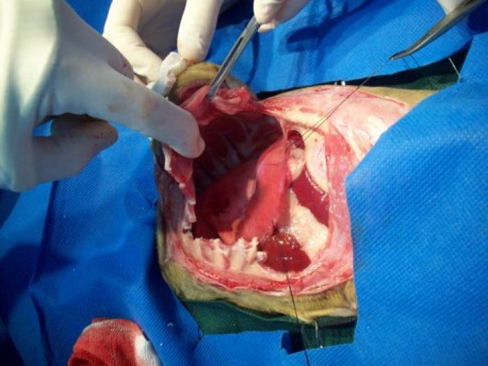 Figura 2. (A) Resección abdominocostal en bloque. (B) Avance diafragmático. (C) Omentalización del defecto abdominal. (D) Malla implantada e inicio de síntesis cutánea.