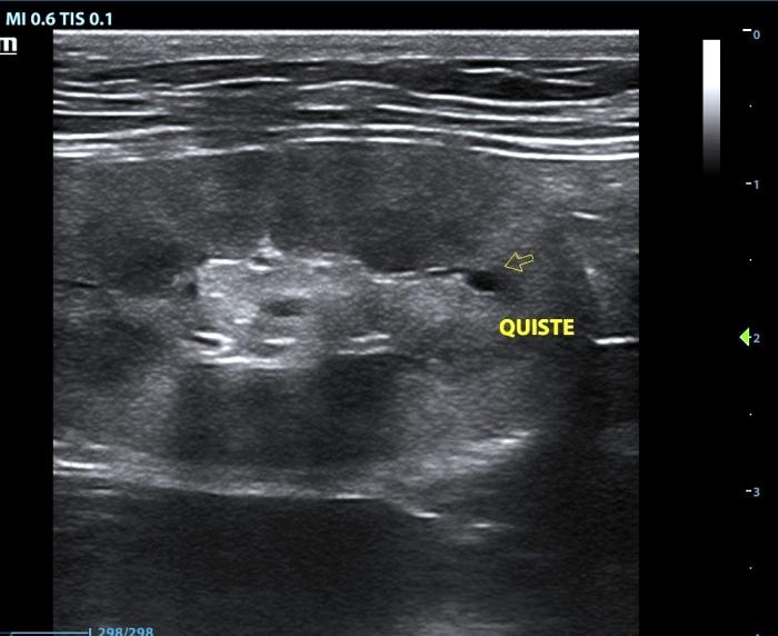 Figura 7. Quiste cortical único en un riñón con ERC. Se observa además un infarto renal en el polo caudal y menor diferenciacion corticomedular.