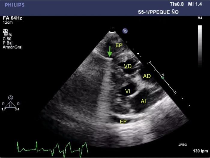 Figura 3 (A, B). Imágenes ecocardiográficas obtenidas por el acceso lateral derecho en (A) longitudinal y (B) transversal en modo BD mostrando la presencia de estructuras hiperecogénicas (flecha verde) que producen artefacto en forma de cola de cometa situados en el epicardio apical del ventrículo derecho (VD). En la imagen A se aprecia transición del ritmo sinusal a ritmo idioventricular. VI, ventrículo izquierdo; AI, atrio izquierdo; AD, atrio derecho; EP, efusión pleural.