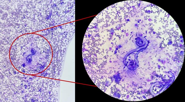 Figura 22. Larvas de parásito pulmonar (Aelurostrongylus spp), abundante componente hemático (presente en las secreciones bronquiales) y células inflamatorias dispersas. La citología no siempre muestra detalle suficiente para especificar la especie, por ello se prefiere la confirmación por test de antígeno o preparaciones húmedas del propio lavado