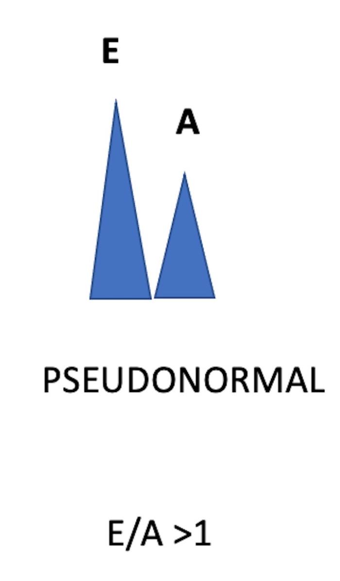 Figura 6. (A) Patrón trasmitral pseudonormal, onda E superior a onda A, ratio E/A>1. (B) Patrón pseudonormal en un perro con EVMD Fase B2, obsérvese la onda E de alta velocidad.