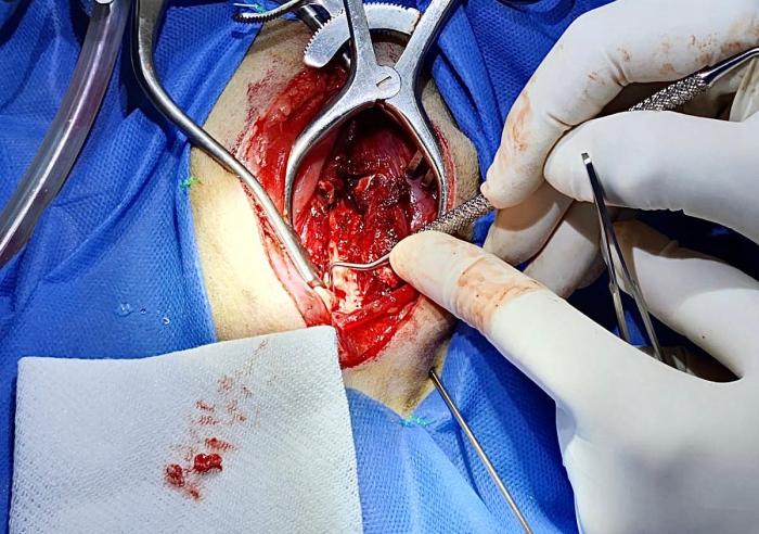 Figura 3. Extracción de material discal extruido.