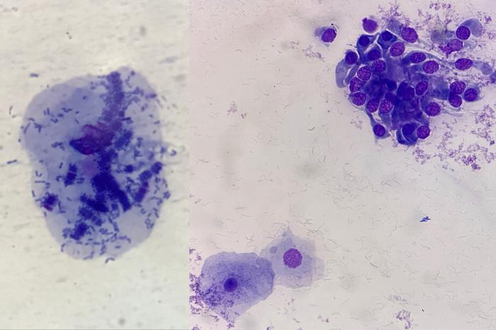 Figura 13. La presencia de Conchiformibius spp (izquierda) y/o células de epitelio escamoso (derecha) sugieren contaminación orofaríngea, y se debe tener precaución al interpretar cualquier resultado del LBA. Conchiformibius spp se caracteriza por su división longitudinal y su disposición en filas paralelas, lo que puede confundirse con una bacteria de mayor tamaño. Obsérvese en la imagen izquierda la presencia de cilios rotos dispersos en el fondo de la preparación.