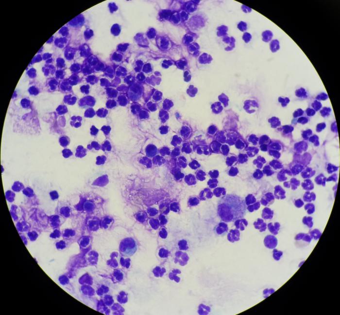 Figura 18. Los neutrófilos en el moco bronquial tienen una apariencia similar a los neutrófilos del sangre periférica, pero pueden mostrar cambios degenerativos o estar rotos por el efecto de la recolección y preparación.