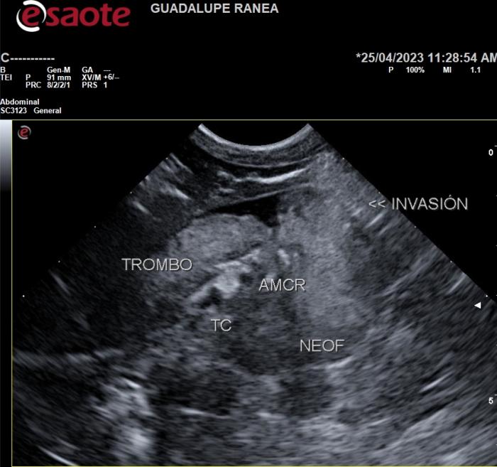 Figura 1. Neoplasia adrenal izquierda vista desde un abordaje coronal derecho. Se observa la neoformación invadiendo la vena vaca caudal y la presencia de un trombo hemático en proximal. AC: arteria celíaca. AMCR: arteria mesentérica craneal.