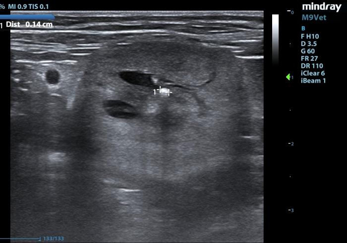 Figura 3. Nefrolitasis. El tamaño de este nefrolito, de 1.4 mm es susceptible de movilizarse al uréter y ocasionar obsrucción ureteral.