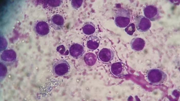 Figura 3. (A) Presencia de células redondas con vacuolas en su citoplasma. Tinción 15. Objetivo 100X. (B) Células redondas con vacuolas en su citoplasma. Tinción 15. Objetivo 100X.