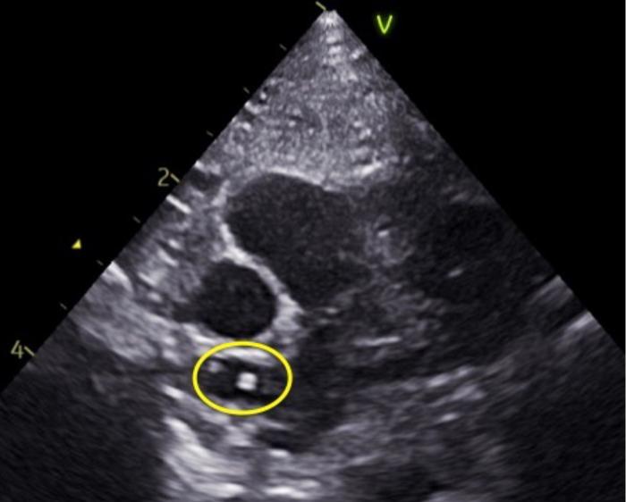 Figura 2. Imagen ecocardiográfica obtenida en la vista paraesternal derecha, corte transversal o de eje corto, a nivel de la bifurcación de las arterias pulmonares. Se observan líneas paralelas hiperecogénicas compatibles con parásitos adultos de Dirofilaria immitis.