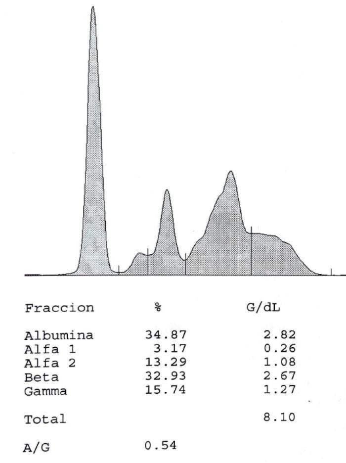 Figura 10A-B. Curva del proteinograma (A) antes del tratamiento y (B) tres meses después del tratamiento.