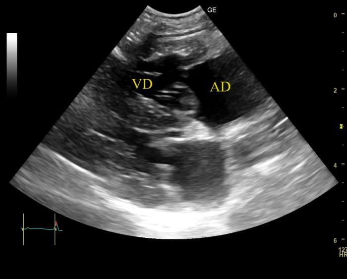 Figura 1. Corte paraesternal derecho eje largo 4 cámaras del caso 1. Se observa dilatación del atrio derecho (AD) e hipertrofia concéntrica del ventrículo derecho (VD).