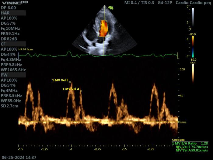 Figura 13. Ecocardiografía Doppler en un gato con HCM. Proyección paraesternal izquierda apical 4 cámaras. (A) Doppler pulsado a nivel de la válvula mitral y (B) Doppler tisular a nivel del anillo lateral de dicha válvula. Los parámetros obtenidos indican un patrón de función diastólica normal.