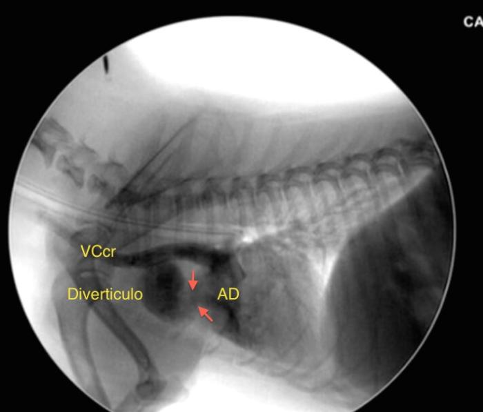 Figura 3. Imagen de la captura de la fluoroscopia en la que se observa el estrechamiento o cuello entre la aurícula derecha (AD) y el divertículo.
