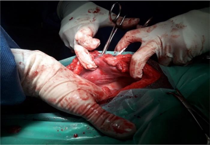 Figura 8. Imagen intraquirúrgica de eversión de la pared abdominal del lado derecho, haciendo uso de pinzas de campo, para realizar una segunda incisión a través del peritoneo.