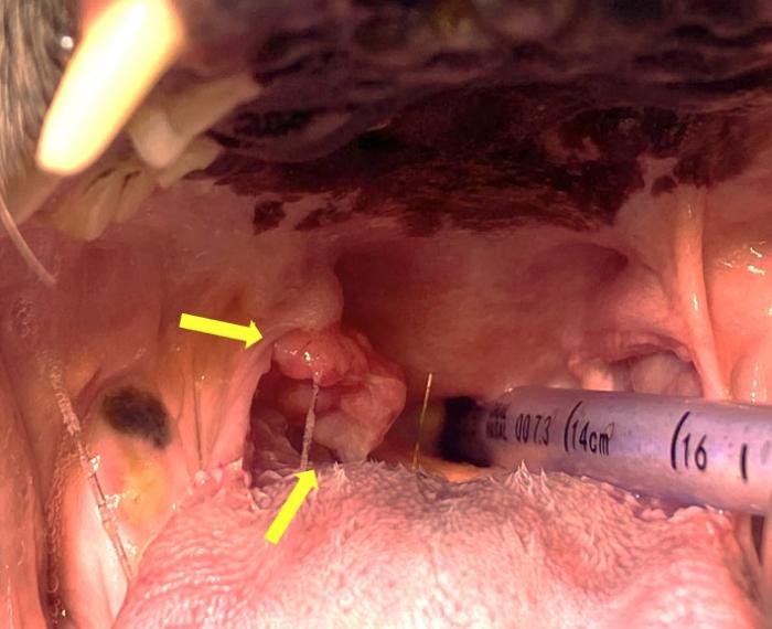 Figura 4. Neoplasia relacionada a la tonsila derecha.