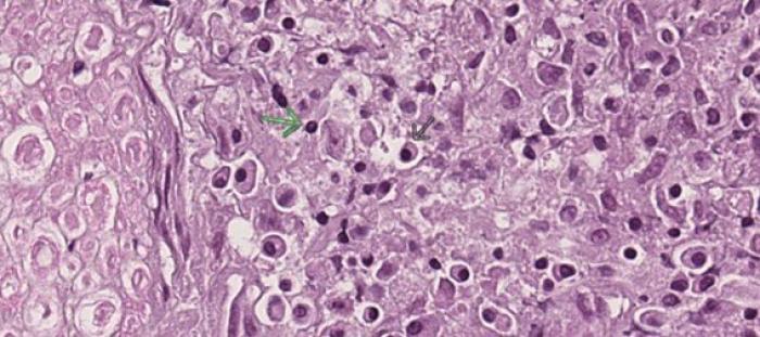 Figura 9. Médula espinal. Se observa un infiltrado inflamatorio en las leptomeninges. Imagen ampliada mostrando el infiltrado de tipo linfoplasmocitario. La flecha negra indica una célula plasmática. La flecha verde muestra un linfocito.