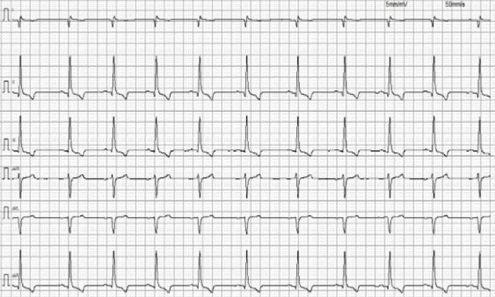 Figura 4A-B. ECG de superficie a los 7 d&iacute;as del episodio. A) ECG 6 derivaciones, 5 mm/mV y 50 mm/s. B) ECG en derivaci&oacute;n II, 5 mm/mV y 50 mm/s.