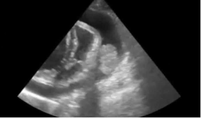Figura 2. Imagen ecocardiográfica del paciente, donde se observa derrame pericárdico, taponamiento cardiaco y una masa cardiaca en el atrio derecho.