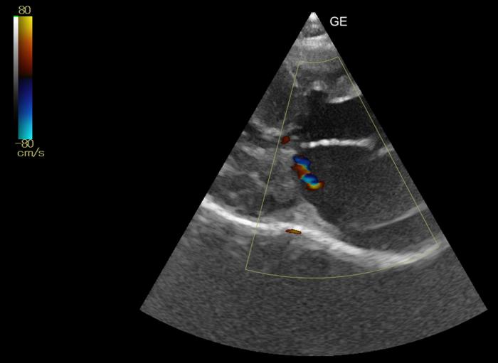 Figura 13. Corte paraesternal derecho en eje largo de 5 cámaras. Insuficiencia en la válvula mitral de poco volumen, asociada a movimiento sistólico anterior de la válvula mitral.