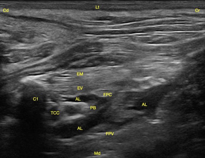 Figura 4. Corte transversal del plexo braquial con abordaje subescalénico tras la infiltración con anestésico local. Se observa la primera costilla (C1), los músculos escaleno medio (EM) y ventral (EV), la fascia profunda del cuello (FPC), la fascia prevertebral (FPV) y entre ellas el plexo braquial (PB) junto con el tronco costocervical (TCC) bañados por el anestésico local (AL). Craneal (Cr), caudal (Cd), lateral (Lt) y medial (Md).