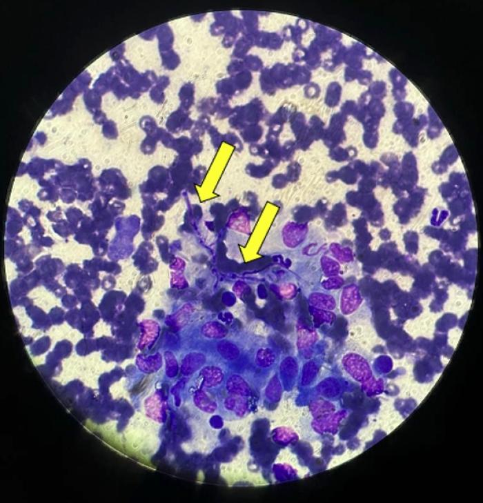 Figura 2. Citología de riñón donde se identifican estructuras alargadas, gruesas, septadas y ramificadas compatibles con hifas, asociadas a macrófagos/histiocitos (flechas).