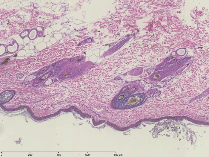 Figura 7 y 8. Estudio histopatológico cutáneo que evidencia acumulaciones anómalas de melanina en el epitelio folicular y los tallos pilosos, con presencia de macromelanosomas e incontinencia pigmentaria leve, hallazgos característicos de alopecia por dilución del color.