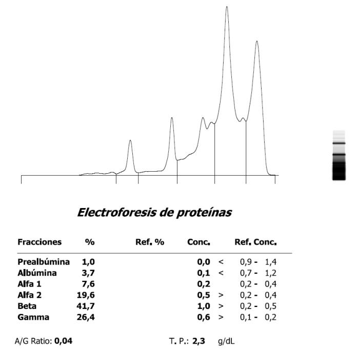 Figura 7. Marcada hipoalbuminemia, aumento de proteínas de fase aguda e hipergammaglobulinemia en una paloma (Columba livia) (A) en el momento de ingreso y (B) evolución postratamiento.